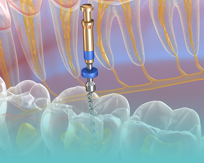 Endodoncja – profesjonalne leczenie kanałowe dla pełnego uśmiechu