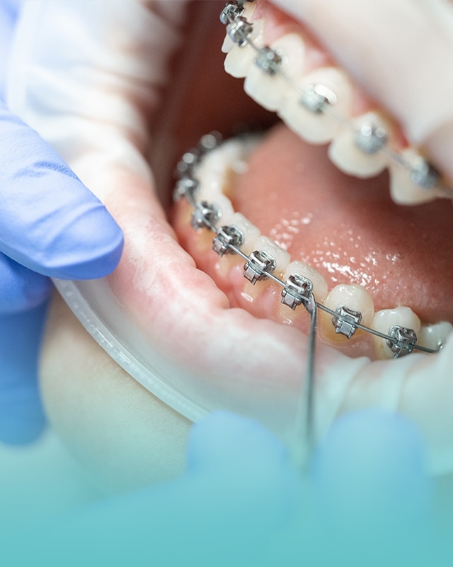 Kompleksowe leczenie ortodontyczne – skuteczna poprawa estetyki uśmiechu